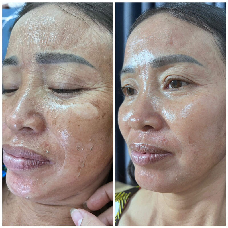 Huyen Phi Cordyceps Skin Peel